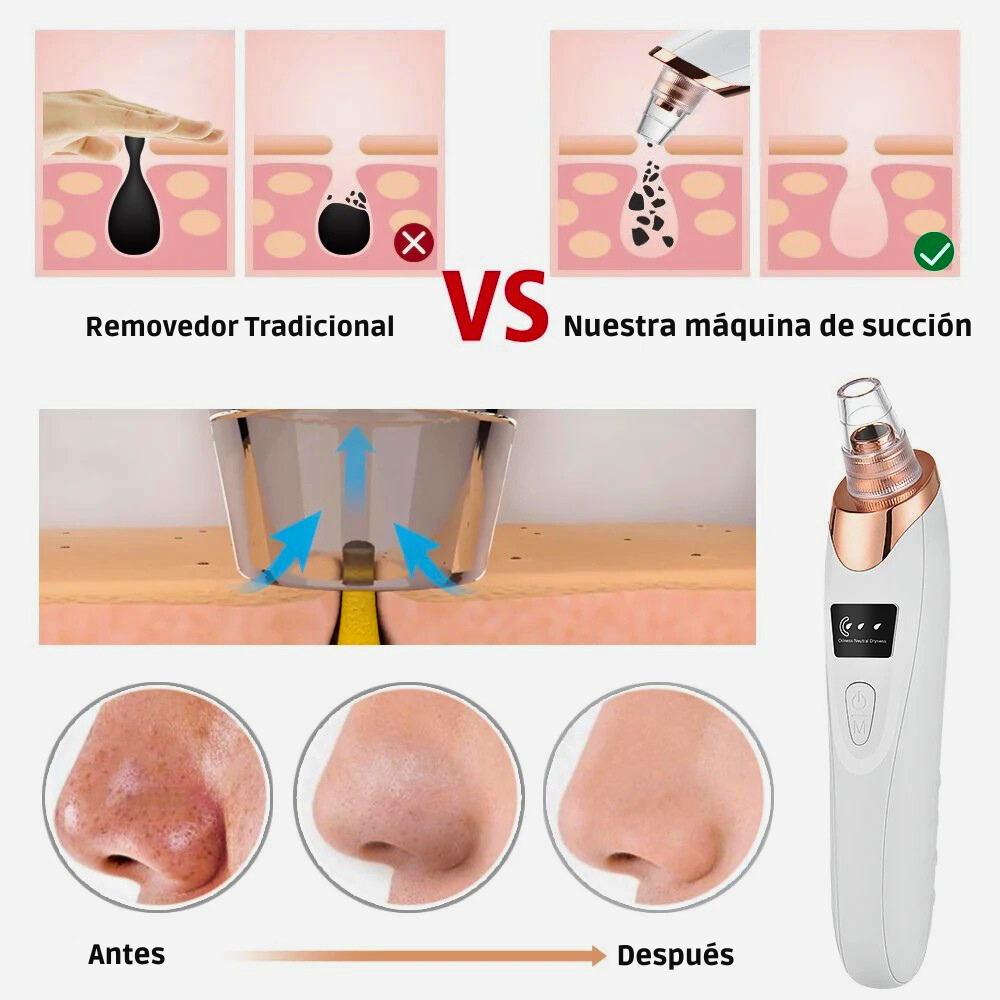 Removedor de Puntos Negros con Succión – Limpieza Facial Profunda y Microdermoabrasión Portátil