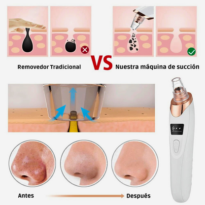Removedor de Puntos Negros con Succión – Limpieza Facial Profunda y Microdermoabrasión Portátil